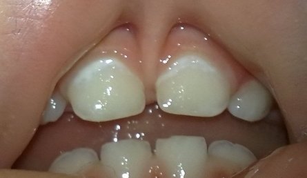 Карієс молочних зубів у дитини