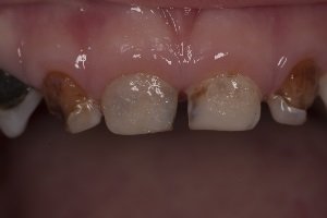 Карієс зубів у дітей