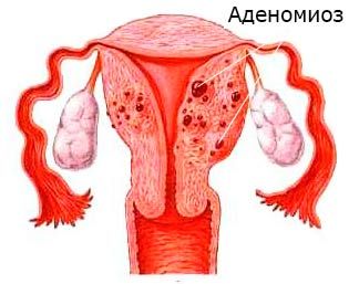 Аденоміоз матки: лікування, симптоми, ознаки