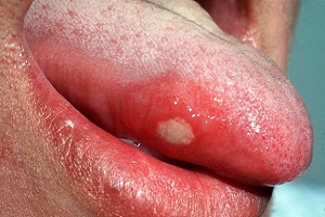 Причини і лікування стоматиту мовою