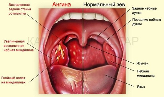 Лікування гострого тонзиліту або чим полоскати горло при ангіні?