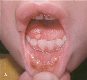 Виразки в роті: в чому причини і як лікувати