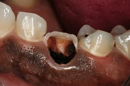 Симптоми пульпіту зуба