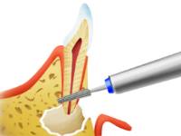 Що таке глубоке фторування зубів?