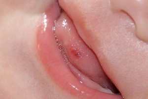 Причини і лікування болячок мовою