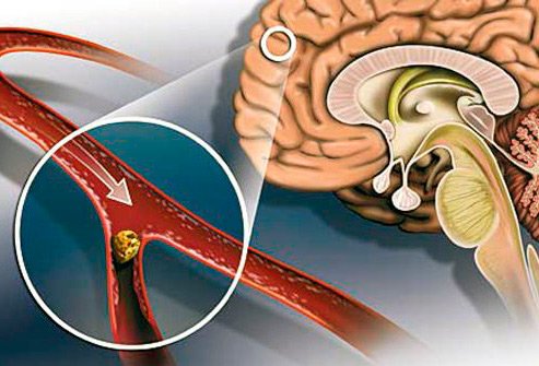 Інсульт головного та спинного мозку: причини, методи лікування
