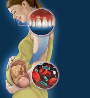 Лікування зубів при вагітності