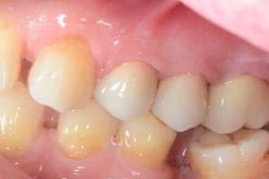 Установка коронок на зуби