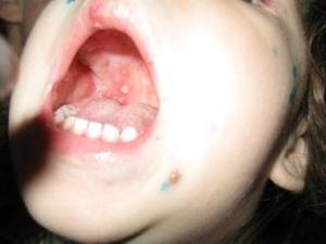 Виразки в роті: в чому причини і як лікувати