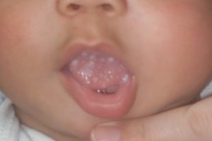 Лікування молочниці в роті у дитини