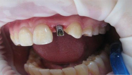 Встановлення зубних імплантатів