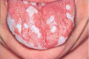 Причини і лікування стоматиту мовою