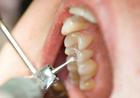 Лікування карієсу у стоматології