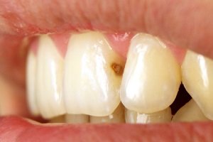 Лікування карієсу на передніх зубах