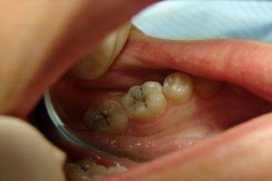 Методи лікування пульпіту зубів