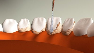 Що робити, якщо десни відходять від зубів