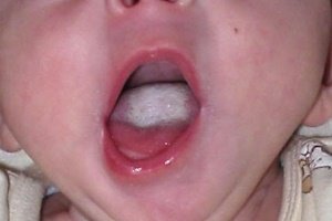 Ознаки і лікування стоматиту у грудних дітей
