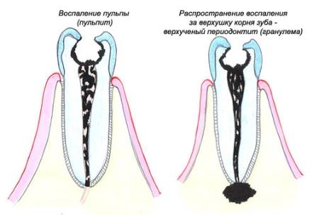Причини і лікування гранульоми на корені зуба