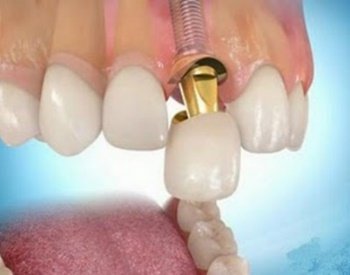 Лікування карієсу на передніх зубах