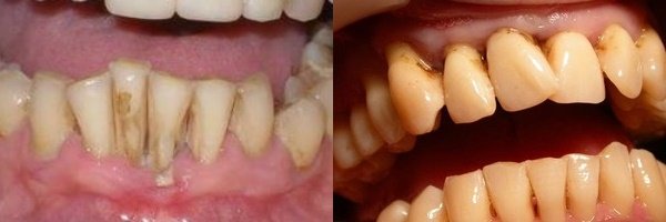Що робити, якщо десни відходять від зубів