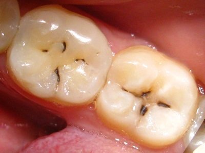 Причини виникнення карієсу зубів
