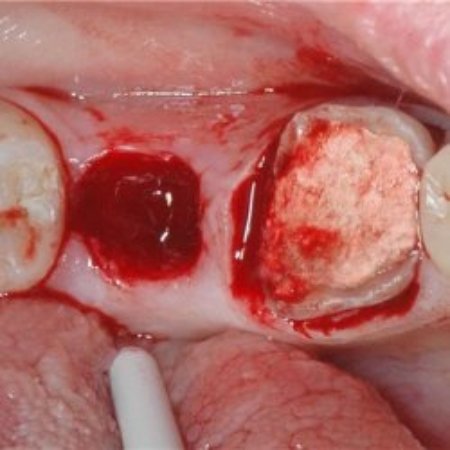Альвеоліт лунки після видалення зуба