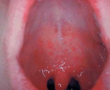 Причини і лікування болячок у роті