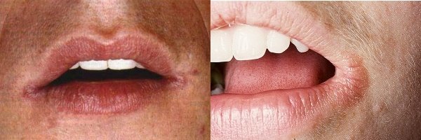 Ефективне лікування заїди на губах