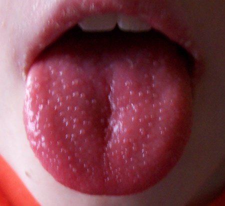 Причини плям мовою у дитини