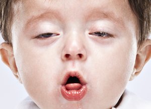 Синдром бронхіальної обструкції і обструктивний бронхіт у дітей