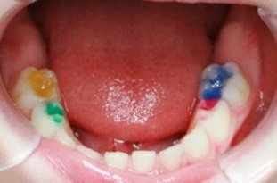 Карієс молочних зубів у дитини