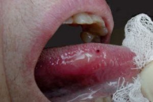 Причини і лікування болячок мовою