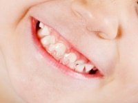 Видалення зубів під загальним наркозом
