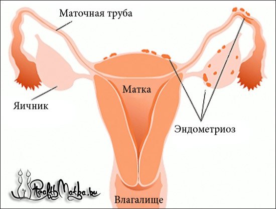 Ендометріоз тіла матки. Ознаки, Внутрішній і дифузний