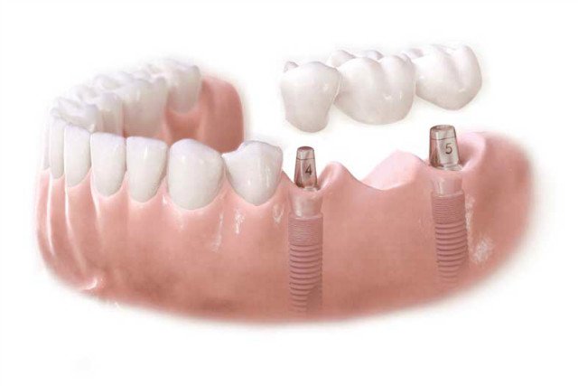 Які зубні протези краще поставити