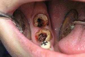 Симптоми пульпіту зуба