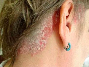 Псоріаз: причини шкірної патології, її симптоми і лікування