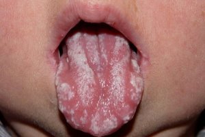 Симптоми і лікування стоматиту у дітей