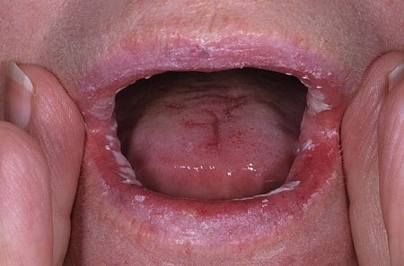 Лікування стоматиту на губі