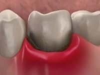 Чим полоскати рот після видалення зубів
