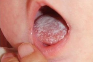 Лікування молочниці в роті у дитини
