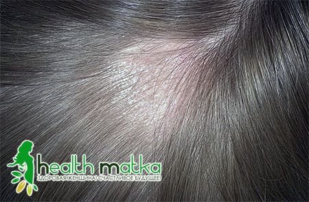 Причини мікозу волосистої частини голови, форми і способи лікування