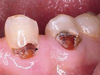 Лікування карієсу у стоматології