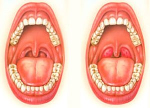 Хвороби горла та гортані: види, симптоми, лікування