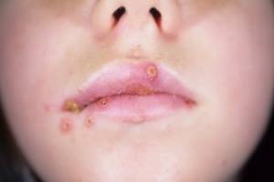 Як вилікувати болячки на губі
