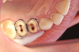 Методи лікування пульпіту зубів