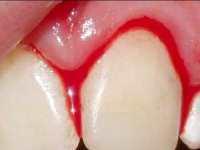 Відгуки на імпланти зубів