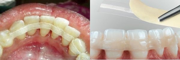 Шинування рухомих зубів при захворюваннях пародонту