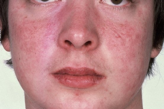 Різновиди та лікування дерматиту на обличчі