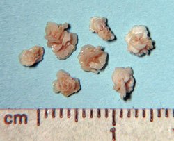 Оксалатні камені в нирках — що це і як лікувати?